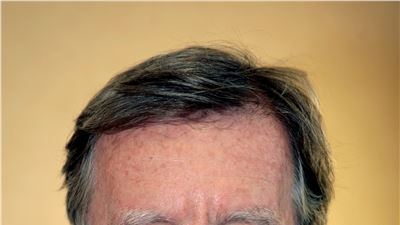 GLI SCAFFOLD RIASSORBIBILI, ULTIMA INNOVAZIONE DELLA CARDIOLOGIA INTERVENTISTICA 